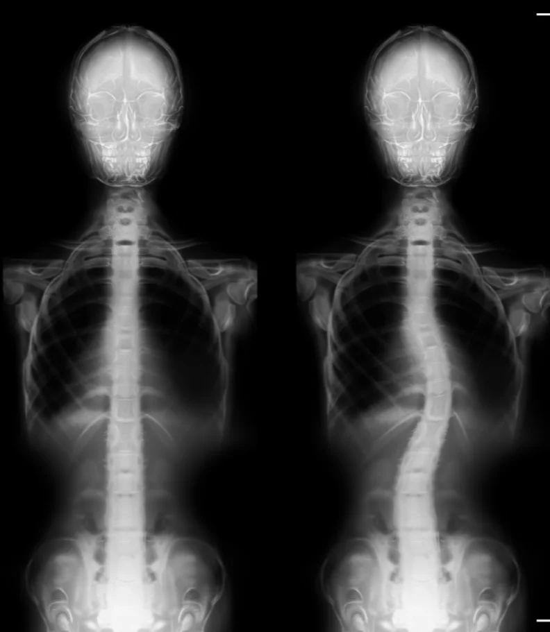 Scoliosis Glastonbury