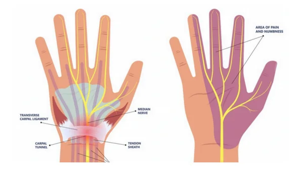how to fix carpal tunnel syndrome
