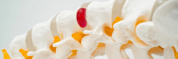 Lumbar Disc Herniation Glastonbury CT