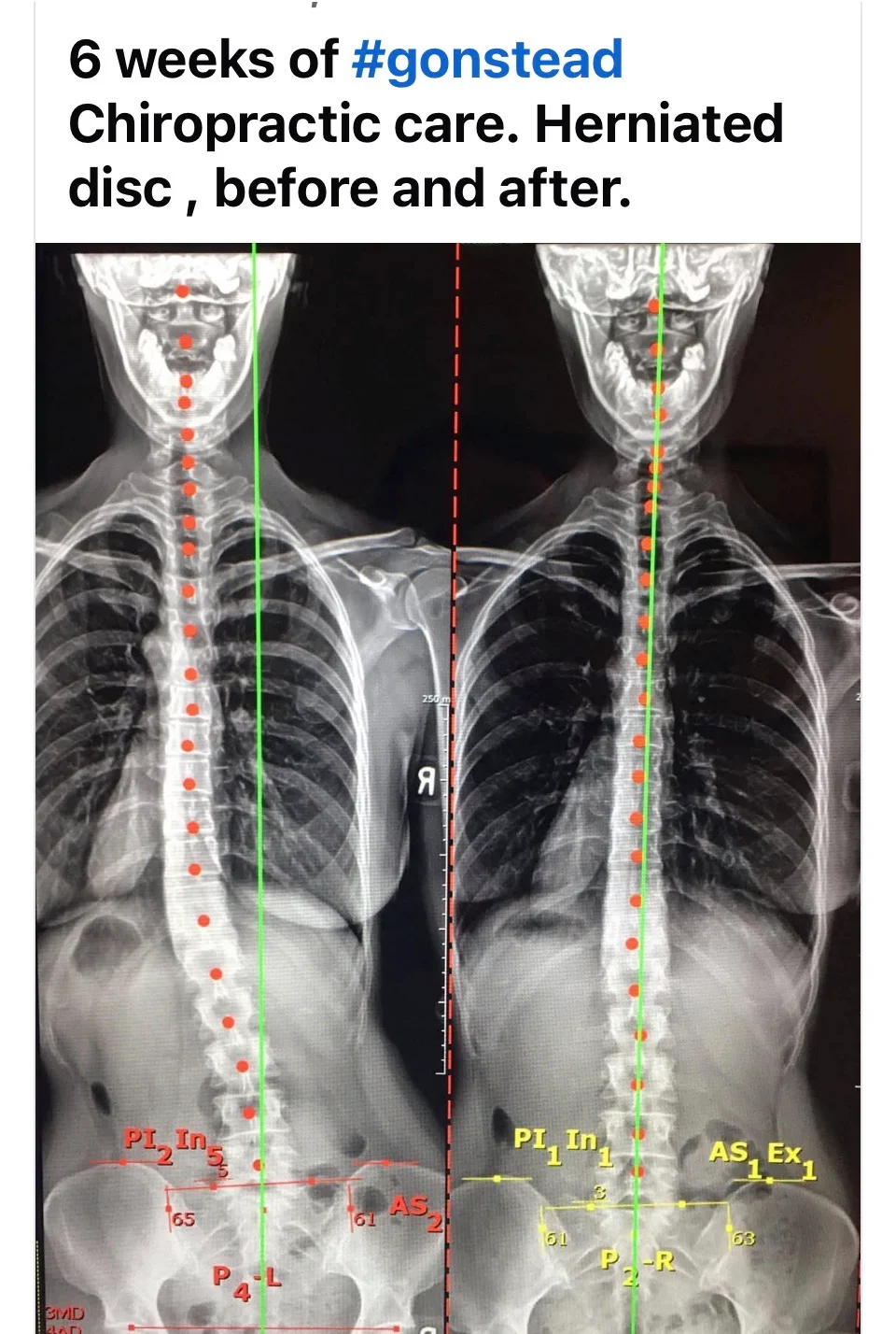 herniated disc in glastonbury