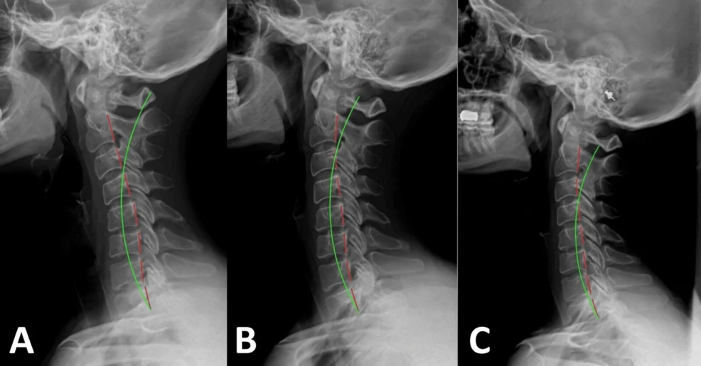 figure 3 cervicogenic